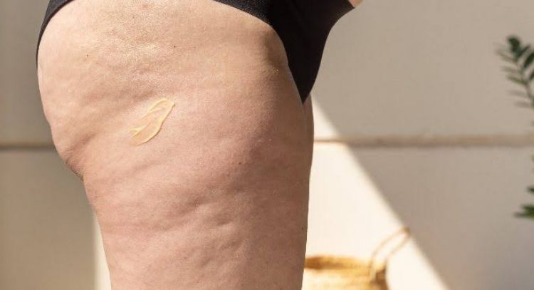 Dile 'bye-bye' a las celulitis en los muslos y glúteos con estos métodos caseros y naturales