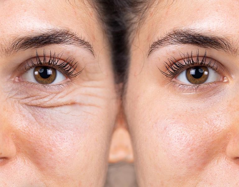 Blefaroplastia: ¿Cuáles son los riesgos de esta cirugía de párpados?