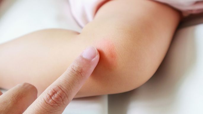 ¿Los mosquitos molestan a tu bebé? Cómo prevenir y aliviar las picaduras