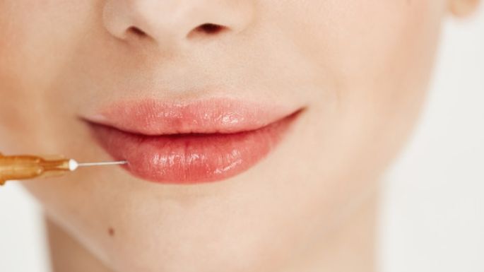 'Lip fillers': Conoce las desventajas y beneficios de este procedimiento estético