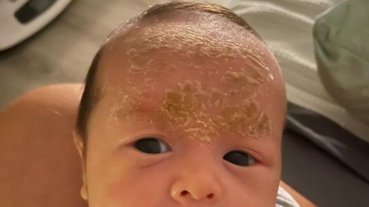 Costra láctea: Así es como puedes eliminar esa desagradable capa de la piel del bebé