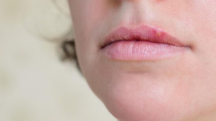 ¿Es herpes labial o solo granito? Aprende a diferenciar estas dos molestias