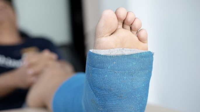 ¿Te fracturaste la pierna? Estas son algunas cosas que tendrás que considerar