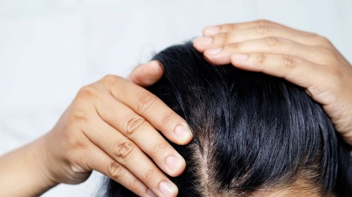 Granitos en la cabeza: Estas son las posibles razones por las que aparecen en tu cuero cabelludo
