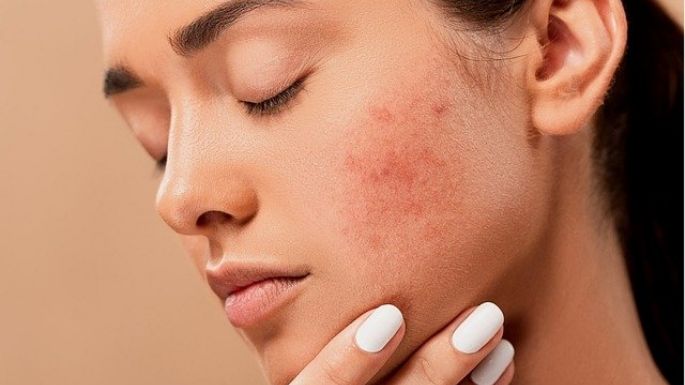 Olvídate del acné con estos remedios naturales y efectivos para combatirlo