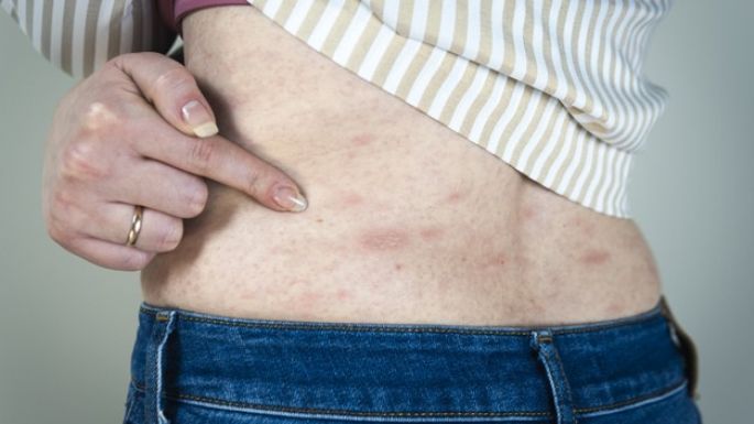 Urticaria por calor: Conoce las causas y síntomas de este molesto problema cutáneo