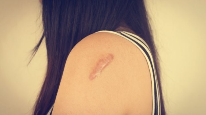 Cicatrices en niños: Así es como deberías tratarlas para que sean menos visibles