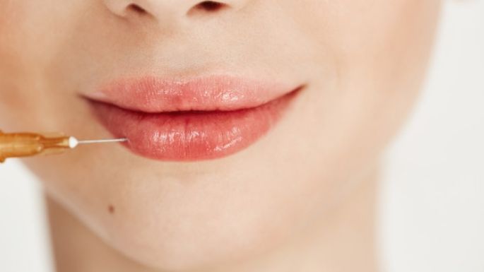 ¿Ácido hialurónico en los labios? Esto es lo que debes saber antes de realizártelo