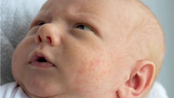 Identifica las posibles razones por las que tu bebé tiene granitos