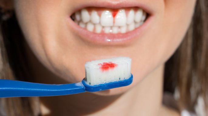 Gingivitis: Conoce las causas, los síntomas y los factores de riesgo de esta enfermedad