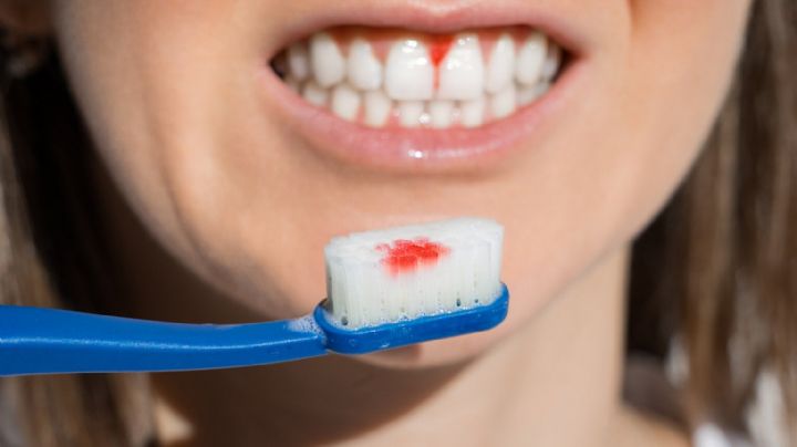 Gingivitis: Conoce las causas, los síntomas y los factores de riesgo de esta enfermedad