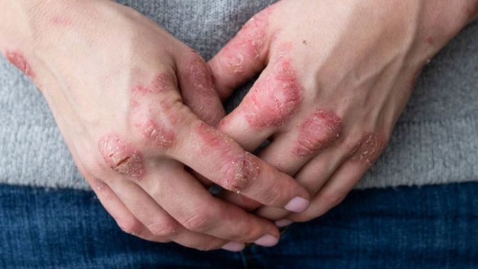 Olvídate del Barmicil, el Dupilumab sería efectivo para la dermatitis atópica