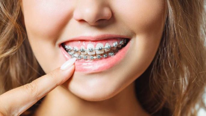 ¿Has visto la moda de los Brackets falsos? Conoce por qué no debes seguirla