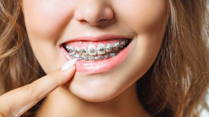 ¿Has visto la moda de los Brackets falsos? Conoce por qué no debes seguirla