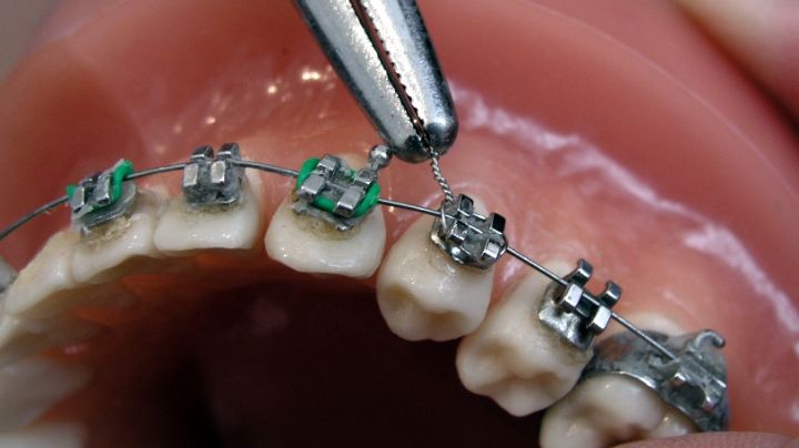 Esta es la edad perfecta para te pongas Brackets y mejores tu sonrisa