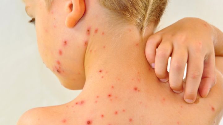 ¿Tus hijos tienen varicela? Así es cómo puedes prevenir las marcas de esta enfermedad