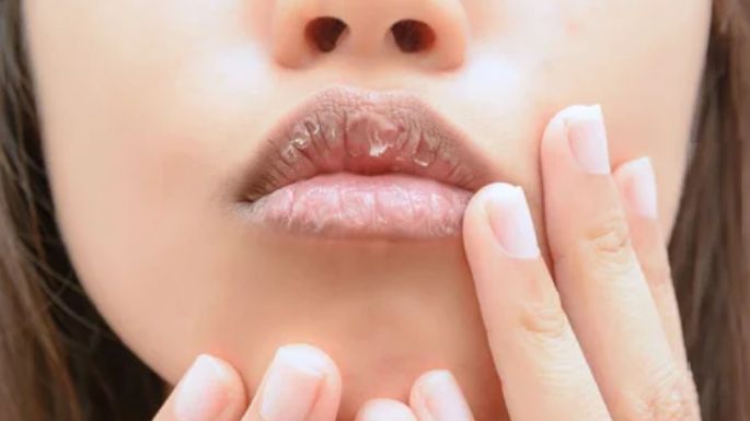 Labios agrietados: Estas son las causas comunes y la forma más rápida de curarlos