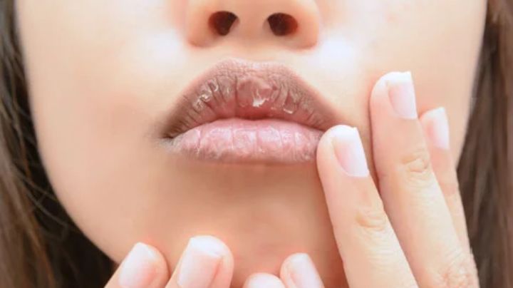 Labios agrietados: Estas son las causas comunes y la forma más rápida de curarlos