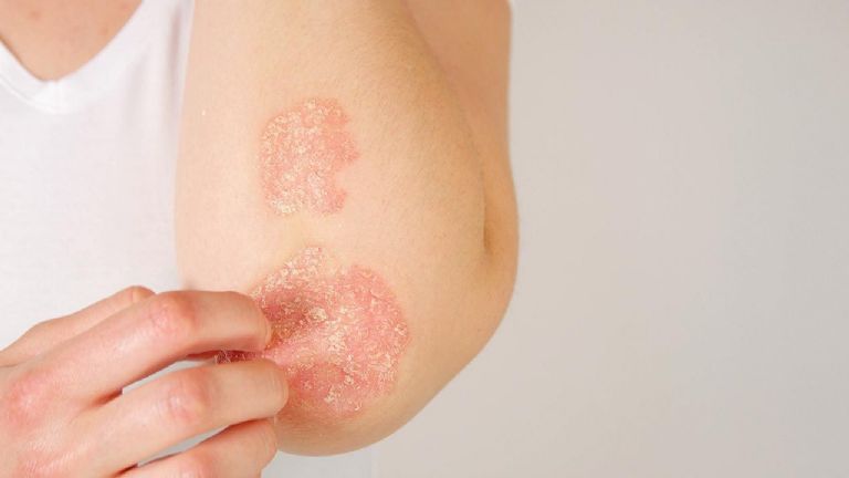 Conoce todo sobre la psoriasis 