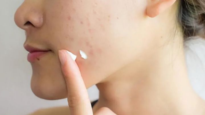 Olvídate de las cicatrices producidas por el acné; 4 remedios para eliminarlas