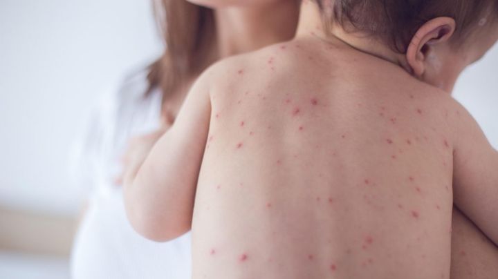 ¿Tu hijo tiene varicela? No te pierdas de 4 remedios caseros que lo ayudarán
