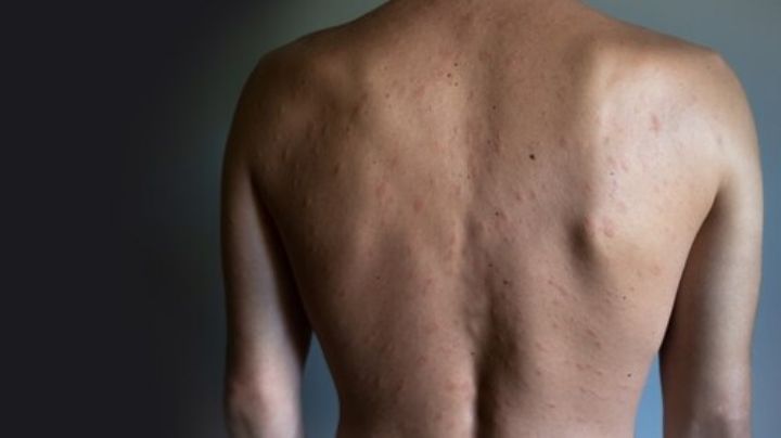 Aprende a aliviar una urticaria desde casa con estos 'tips'