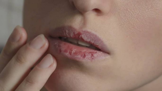 ¿Labios cuarteados? Sánalos con un bálsamo de frambuesa casero