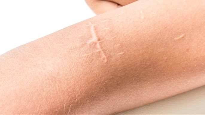 Aprende a cuidar correctamente de las cicatrices para no dañar la apariencia de tu piel