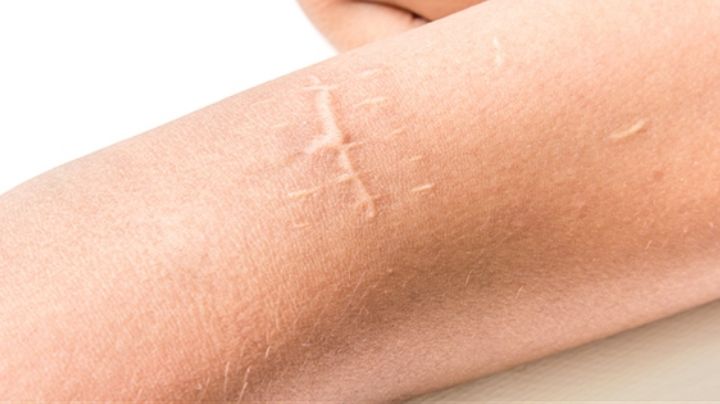 Aprende a cuidar correctamente de las cicatrices para no dañar la apariencia de tu piel