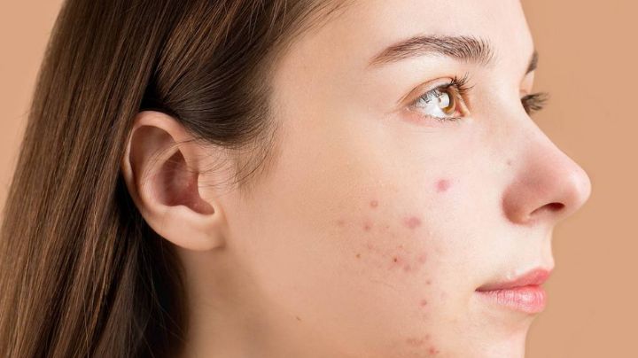 Combate el acné con en la espalda, cuello y cara con este remedio natural