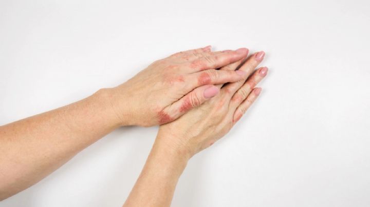 Trata el eczema de tus manos con ayuda de estos dos aceites naturales