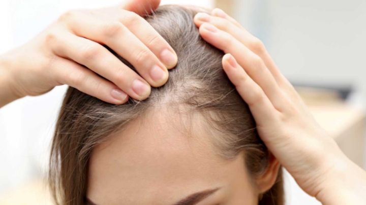 ¿Caída del cabello? Podría ser alopecia; estos son los síntomas