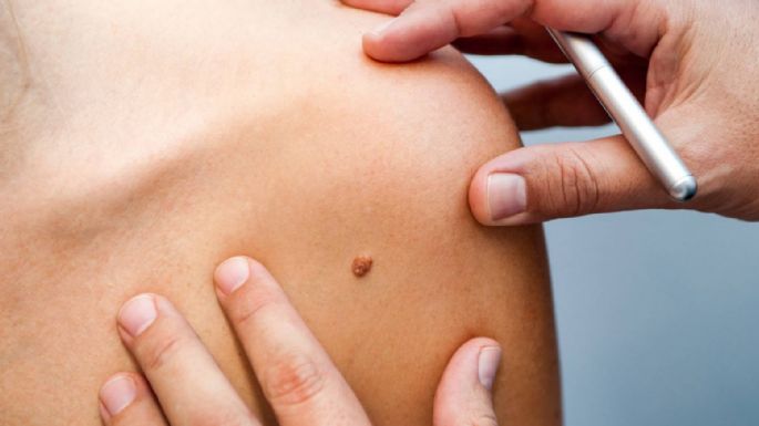 Día Mundial contra el Melanoma: 5 hábitos para prevenir este tipo de cáncer de piel 