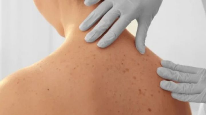 Conoce las características de los lunares causados por el cáncer de piel