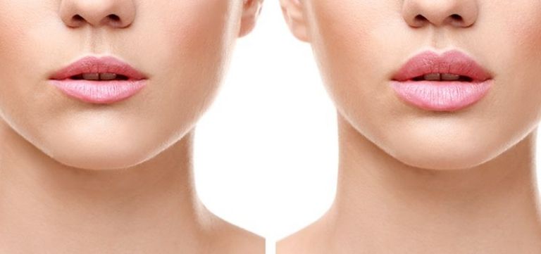 Para unos labios más grandes y jugosos los voluminizadores de labios son la opción