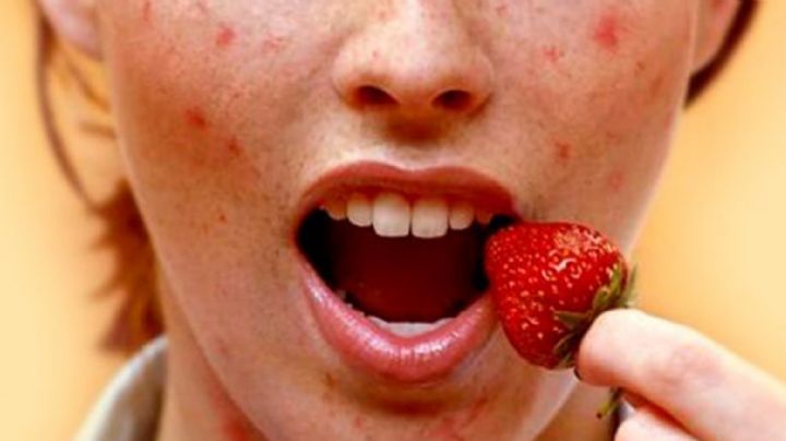Tener alergias alimentarias podría ser un protector contra el Covid-19; ¿por qué?