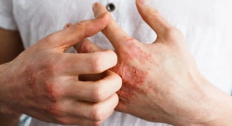 Dermatitis atópica