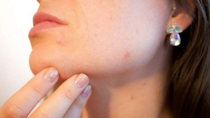 Granitos en el cuello: ¿Por qué salen y cuál es la forma de evitarlo?