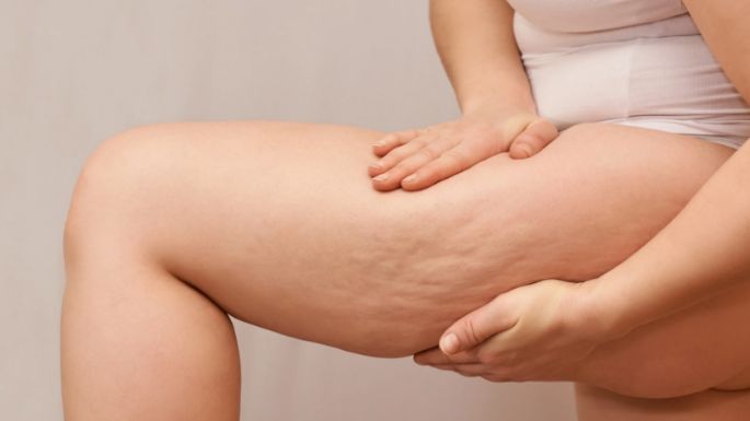 Entérate: Estos son 2 mitos a desterrar sobre las celulitis