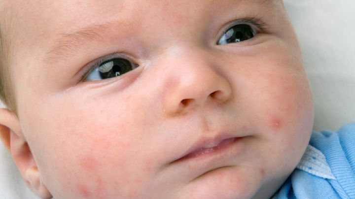 Acné infantil: ¿Cuáles son las causas de los granitos en los bebés?