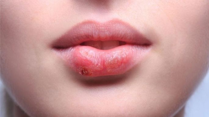 Olvídate de el herpes labial con estos remedios caseros