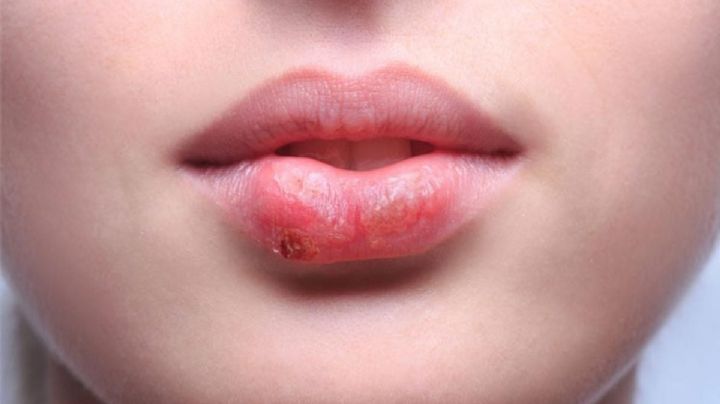 Olvídate de el herpes labial con estos remedios caseros