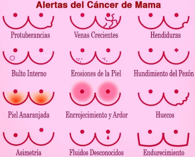 Presta atención a cada cambio en tus senos para poder identificar el cáncer de mama