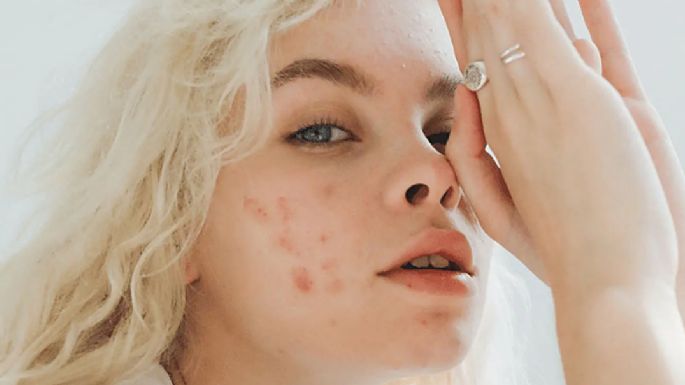 No te quedes sin saber: Estos son los efectos del estrés sobre el acné