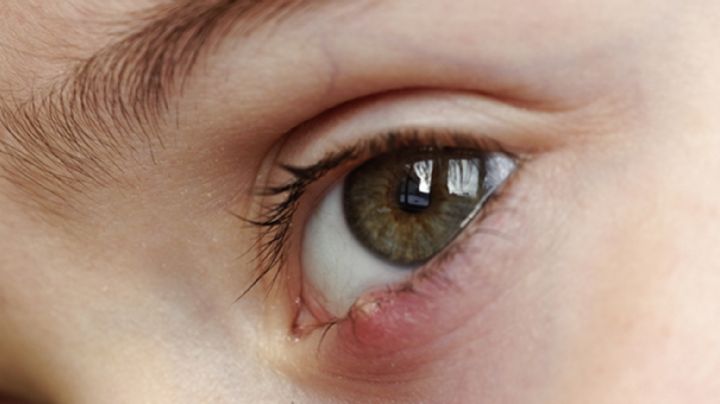 Orzuelos: Qué son y cuáles son los hábitos que podrían ocasionar este daño a la salud de tus ojos