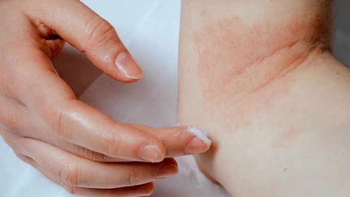 Piel seca o eczema: Estos malos hábitos empeoran la picazón y malestar, según dermatólogos