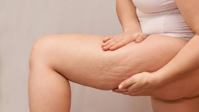 Difumina esas celulitis rebeldes con estas 3 técnicas y luce un cuerpo reafirmado y liso