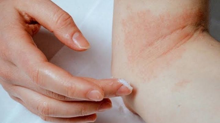 Piel seca o eczema: Estos malos hábitos empeoran la picazón y malestar, según dermatólogos