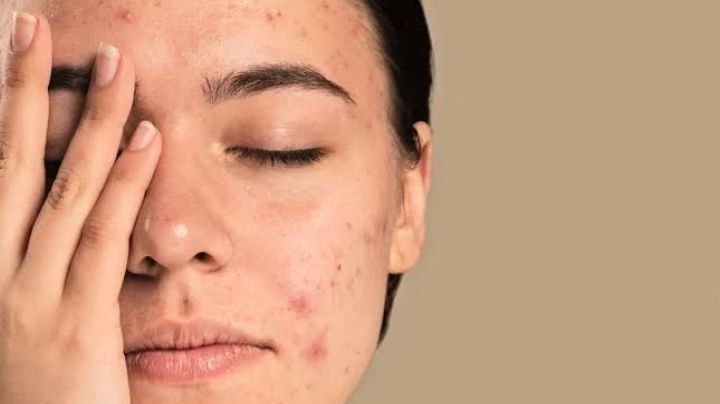 ¿Piel con acné? Desinflama los granitos y evita las cicatrices en el rostro con estos aceites