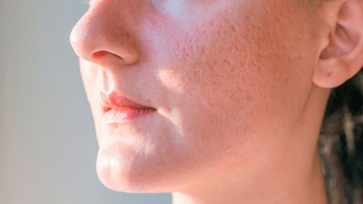 Elimina las cicatrices dejadas por el acné; limpia tu piel de marcas con algunos remedios caseros